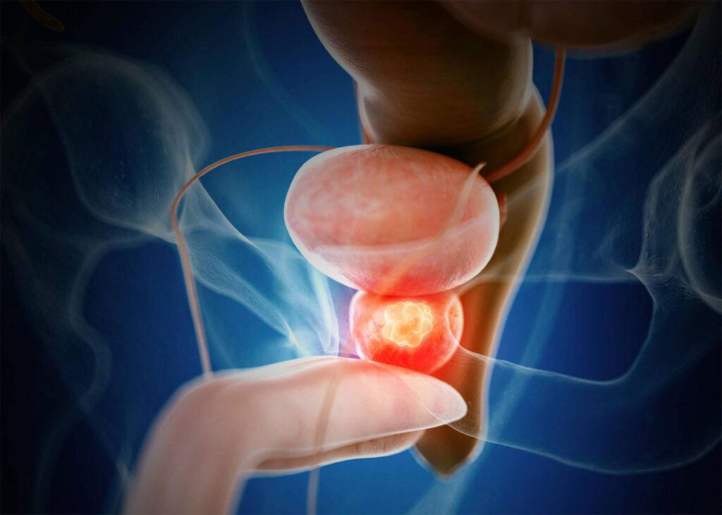 Comprehensive Guide to Prostate Cancer Treatment