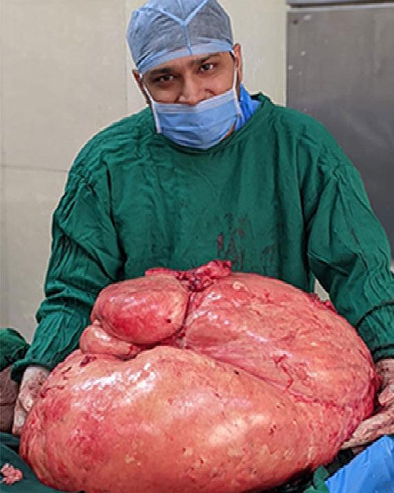 Record-Breaking Surgery: Successful Removal of 48 kg Non-Ovarian Tumor